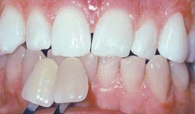 bleaching_1 bleaching_1